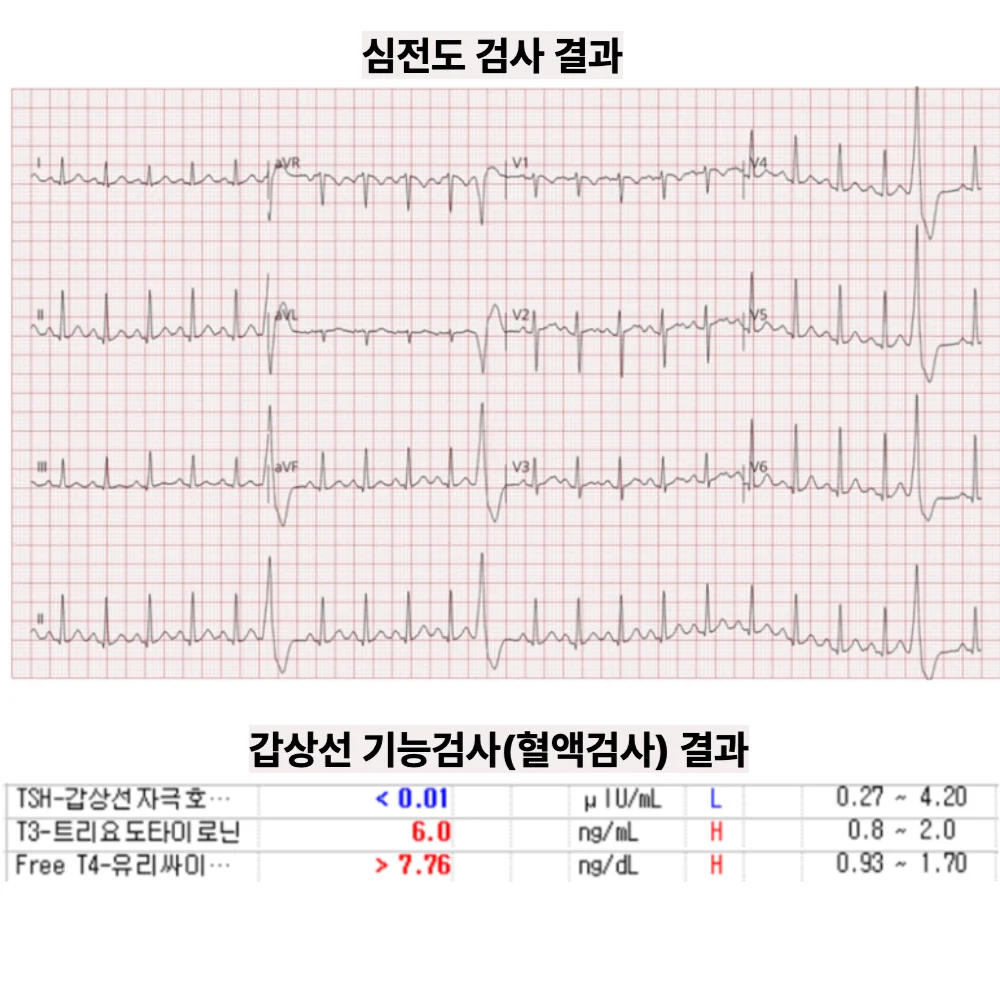 기존 사례의 심전도와 갑상선 기능 혈액검사 결과입니다.