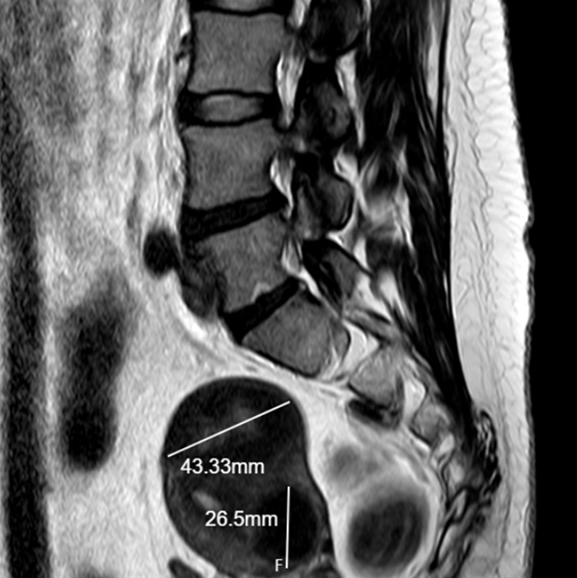 허리 MRI 중 우연 발견 — 4.3cm·2.6cm ‘자궁근종’, 증상 없어 경과관찰 | 분당 판교 영상의학과가 있는 내과 ...