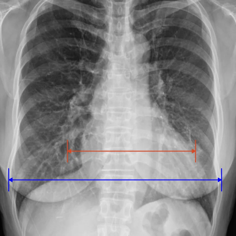 기존 사례 8204에서 심비대가 의심된 흉부 X-ray