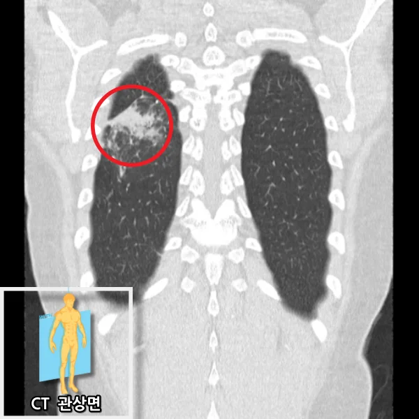 폐렴 소견을 평가한 기존 사례의 흉부 CT 관상면 영상입니다.