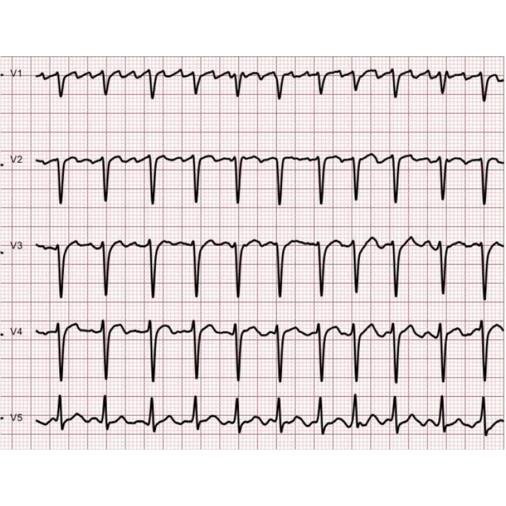 ECG: 빈맥/불규칙 R-R