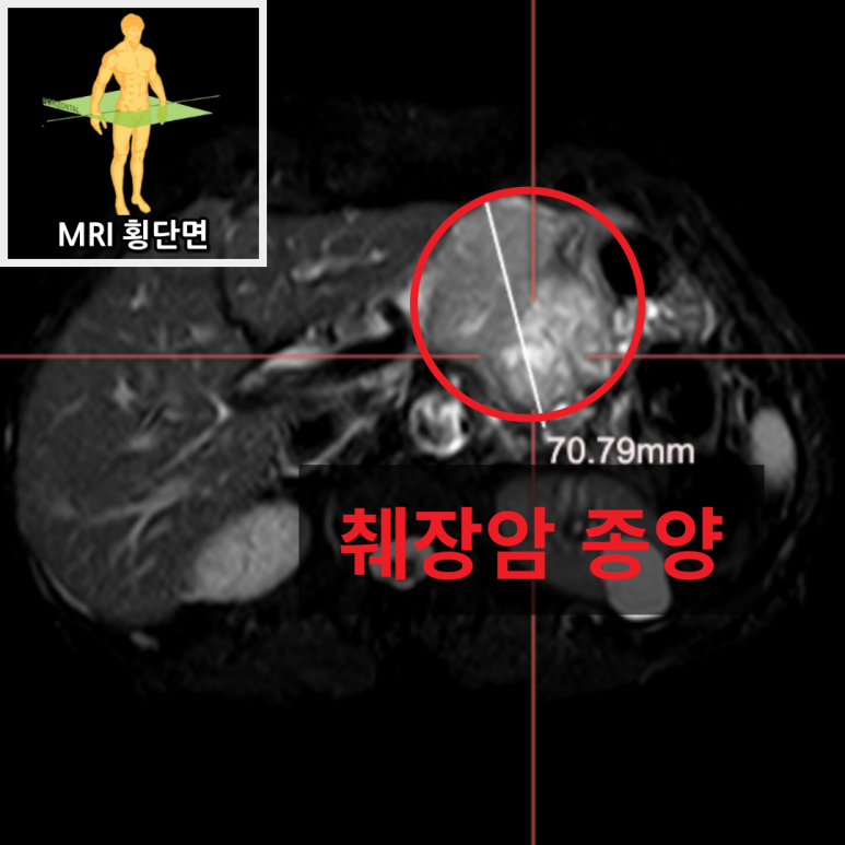 체중감소
