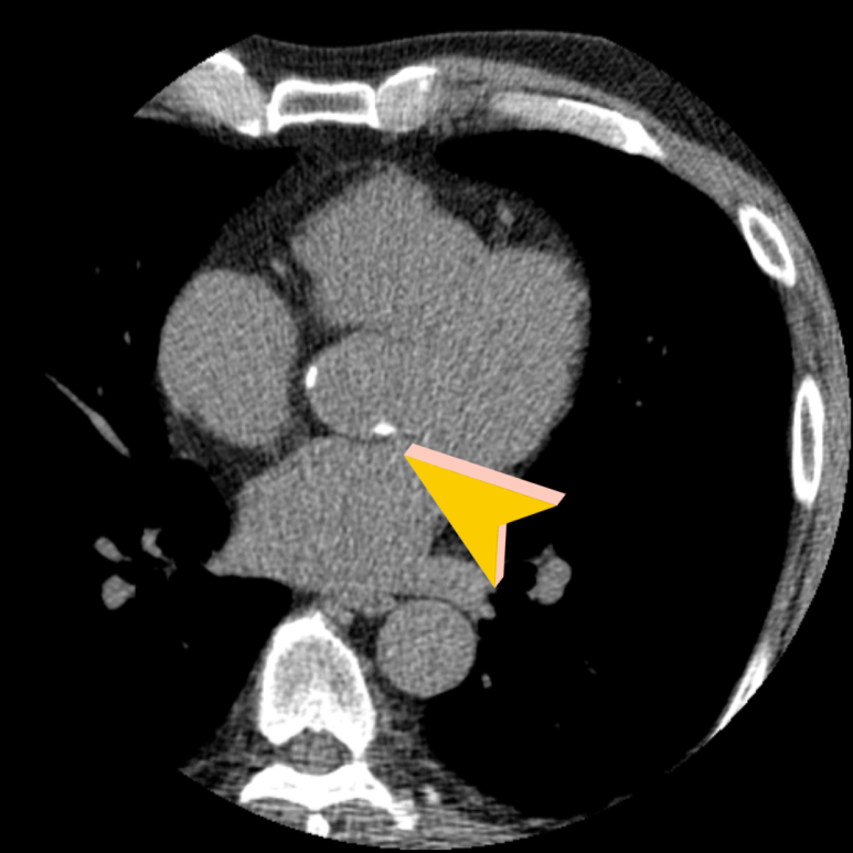 상행 대동맥 석회화