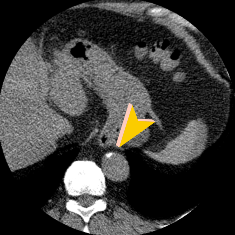 하행 대동맥 석회화