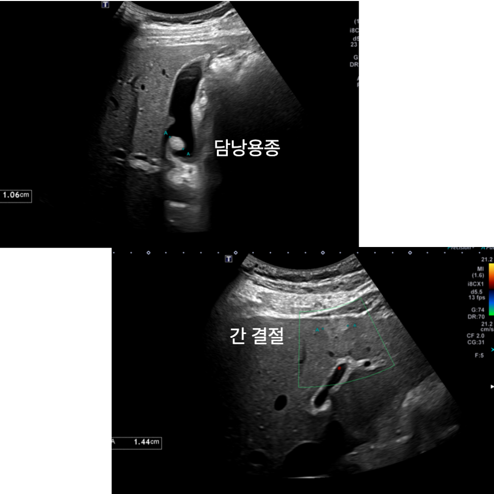 복부초음파: 담낭용종과 간 결절 확인