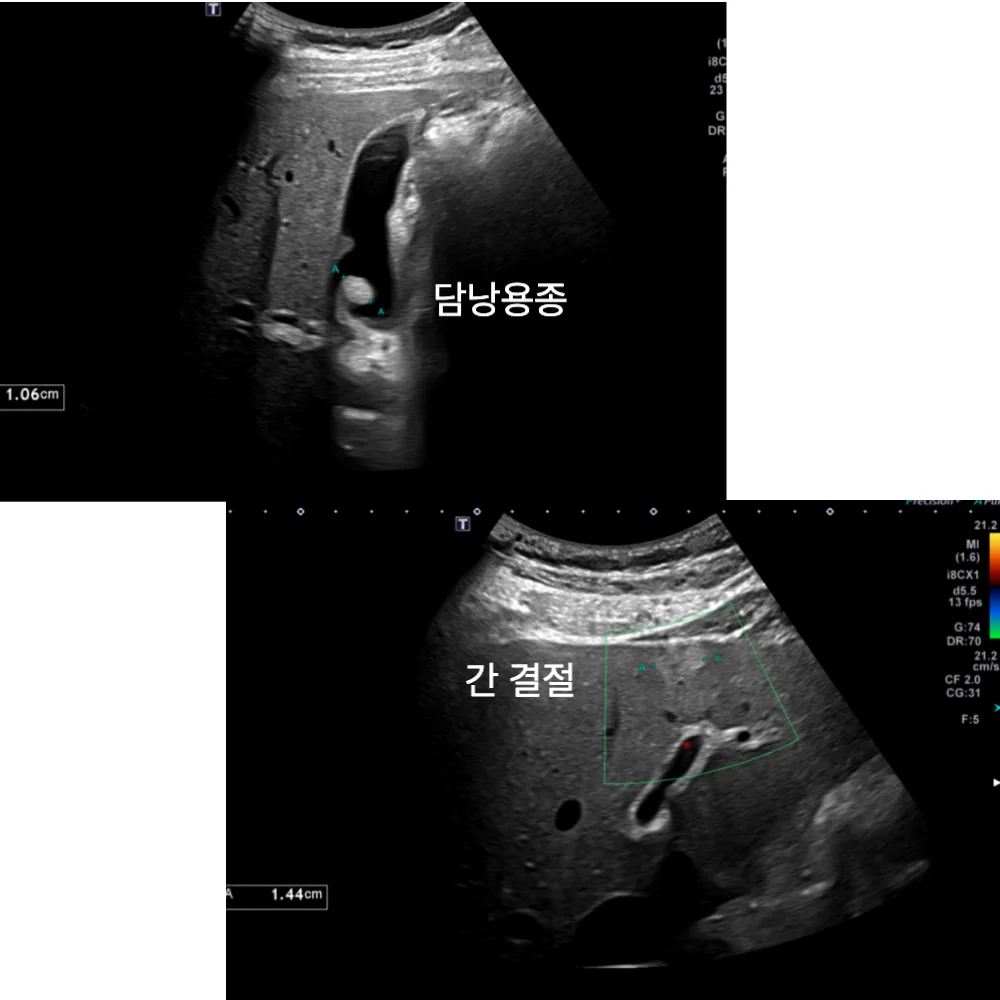 복부초음파: 담낭용종과 간 결절 확인