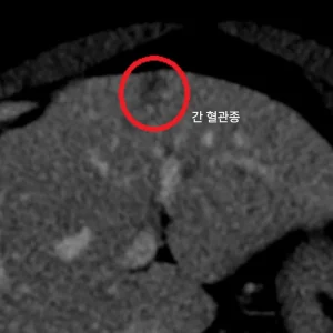 우상복부 통증·속쓰림 — 지방간·담낭용종·간혈관종(양성) 확인