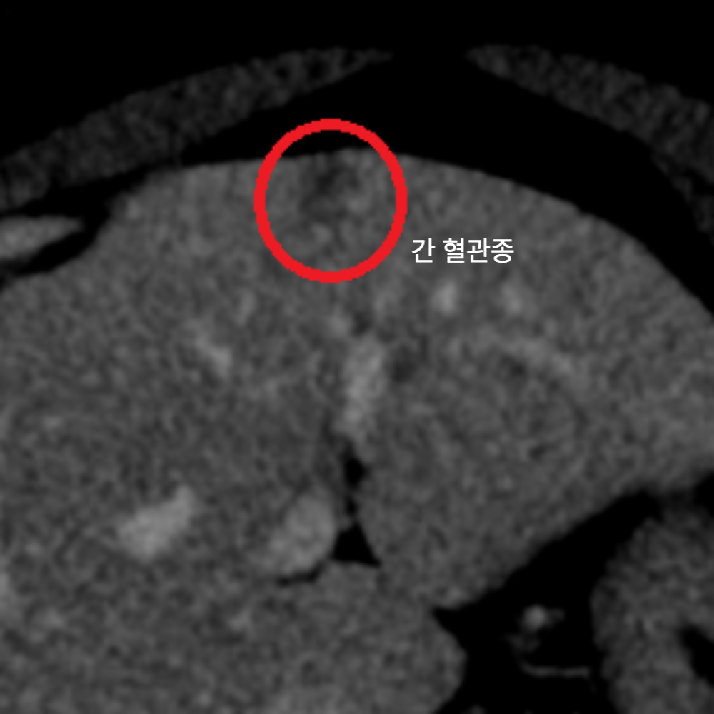 우상복부 통증·속쓰림 — 지방간·담낭용종·간혈관종(양성) 확인