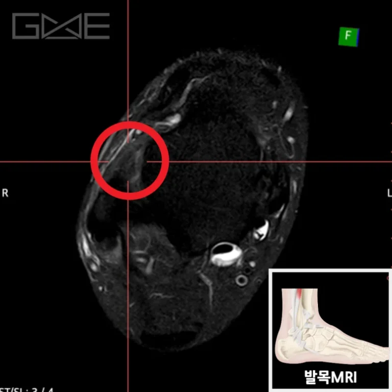 과거 접질림 이후 반복되는 불안정… MRI로 확인된 다발성 인대손상