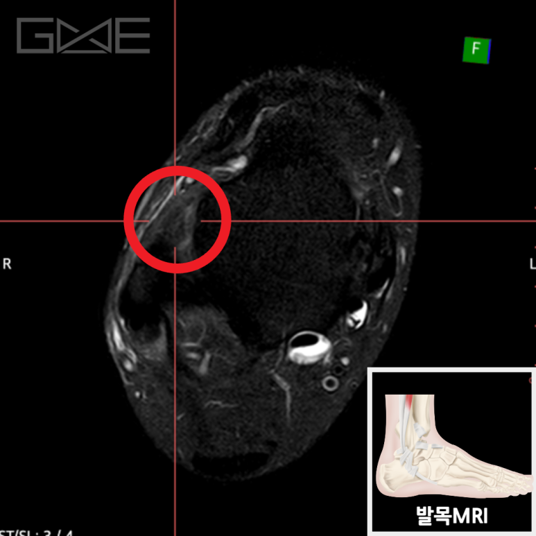MRI: 외측 인대 복합체 손상
