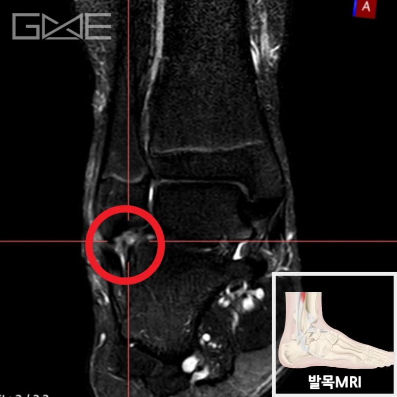 MRI