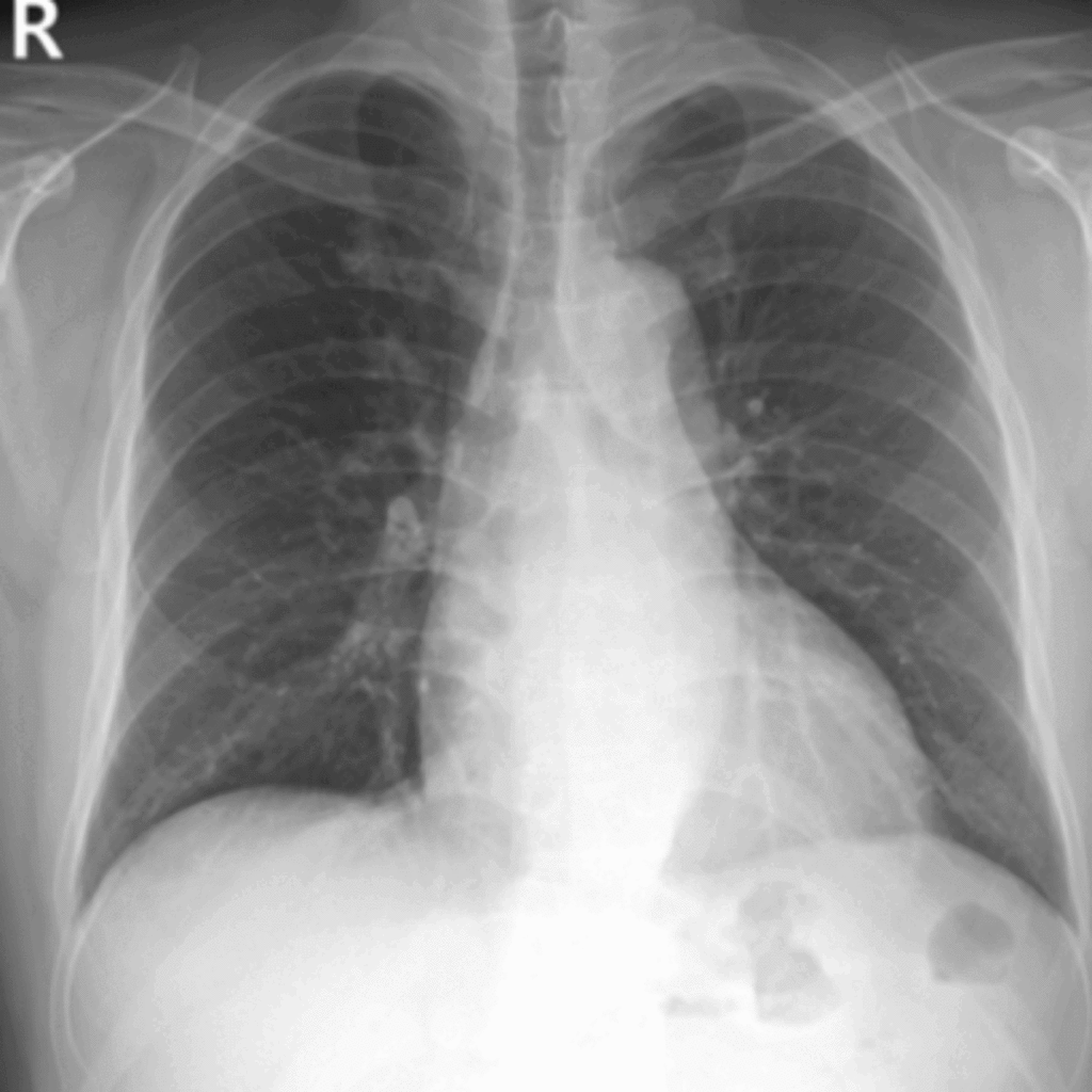 호흡곤란·천식 의심 증상 — X-ray 심장비대, 심초음파로 심부전 확인
