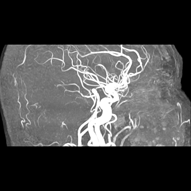 반복되는 두통, 단순 긴장성만은 아닐 수 있습니다 — 뇌 MRA에서 4.4mm 혈관 돌기