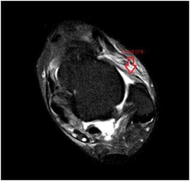 MRI 검사: 인대 손상