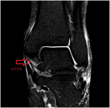 MRI 검사: 인대 손상