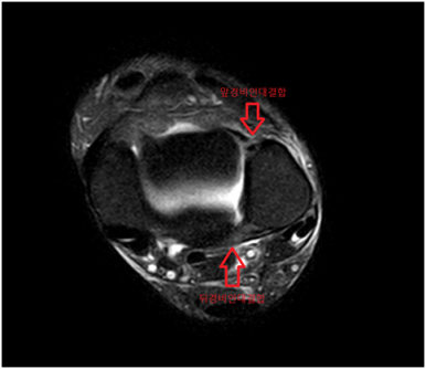 MRI 검사: 인대 손상