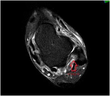 MRI 검사: 인대 손상