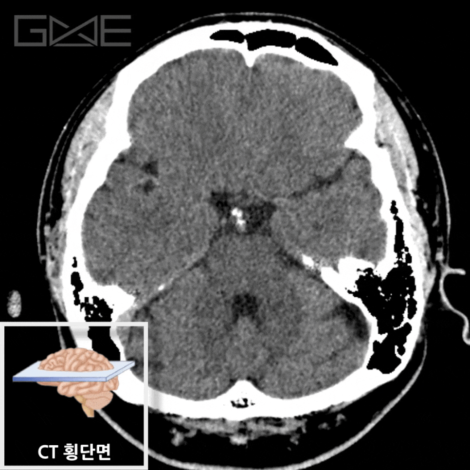 동일 환자의 뇌백질 병변이 뚜렷하게 구분되지 않는 뇌 CT 횡단면 영상