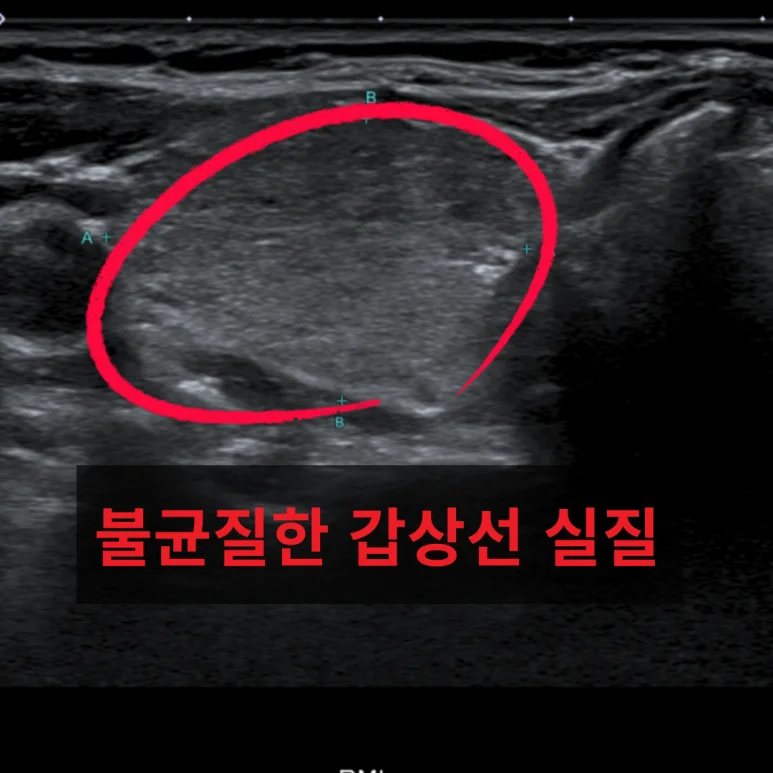 갑상선 초음파: 불균질 갑상선 실질