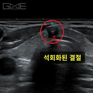 검진 후 6개월 추적 — 5mm 석회화 협부 결절 ‘갑상선유두암’, BRAF 양성