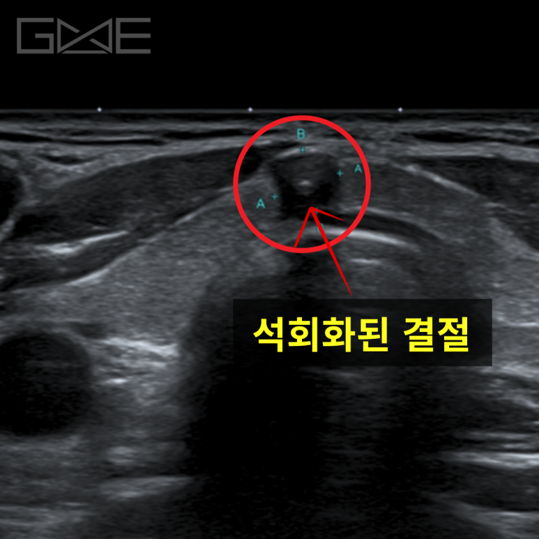 검진 후 6개월 추적 — 5mm 석회화 협부 결절 ‘갑상선유두암’, BRAF 양성