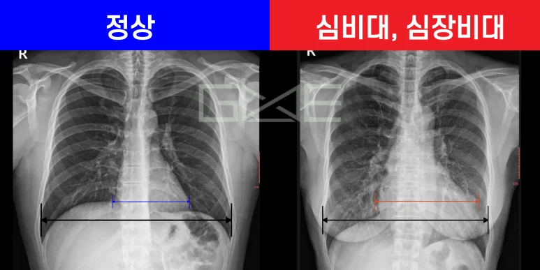 정상 심장과 심비대 심장의 흉부 X-ray 비교 — 오른쪽은 심장 가로 폭이 넓어져 있다