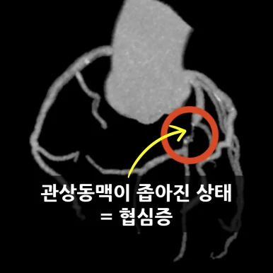 관상동맥 조영술 영상 — 혈관이 좁아진 부분을 표시한 협심증 소견