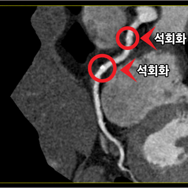 협착 부위 확대