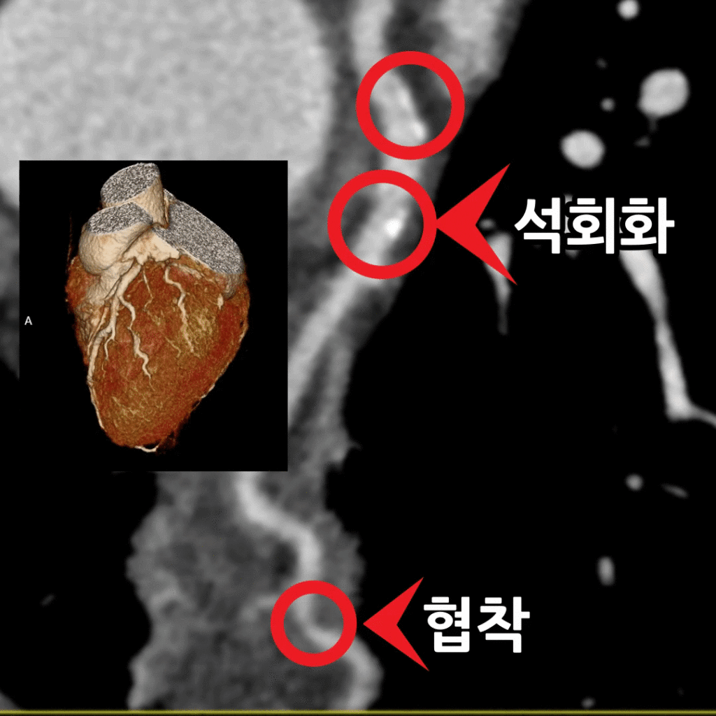 소화불량·가슴조임 — 관상동맥 CT에서 50% 협착과 칼슘점수 295