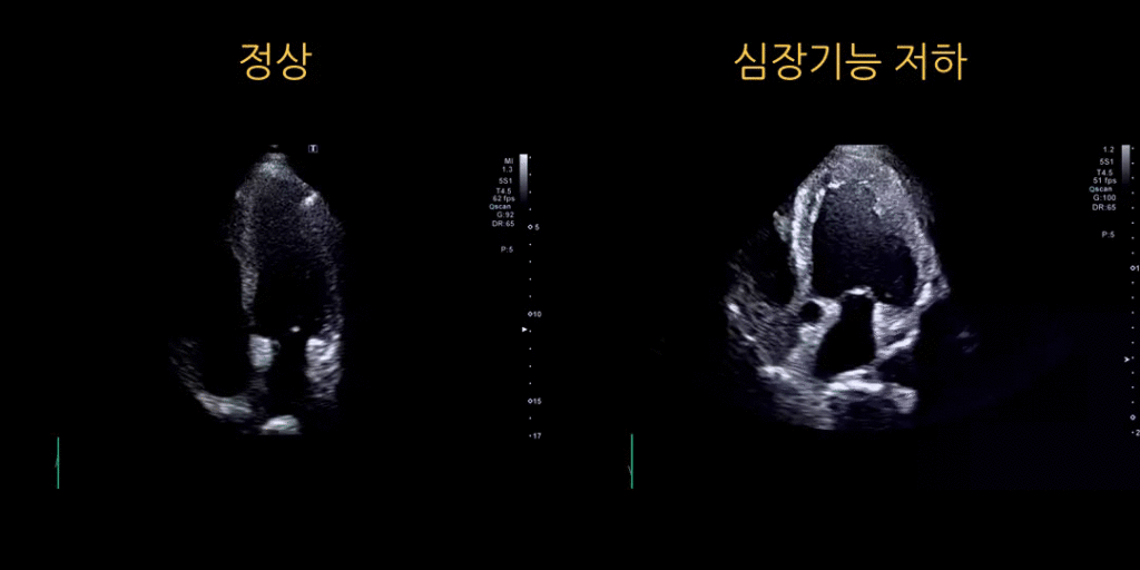 심장초음파 결과: 심장기능 저하