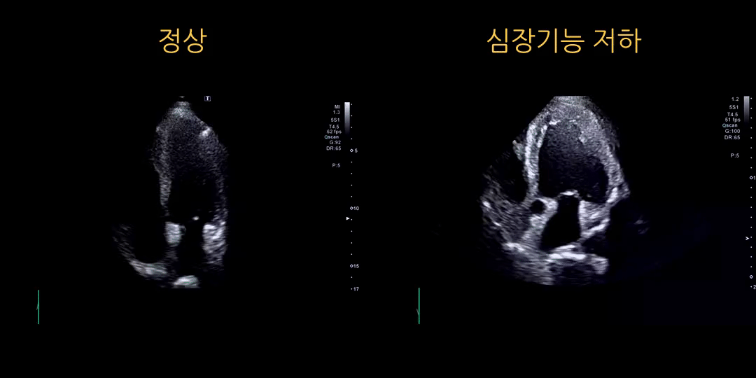 심장초음파 결과: 심장기능 저하