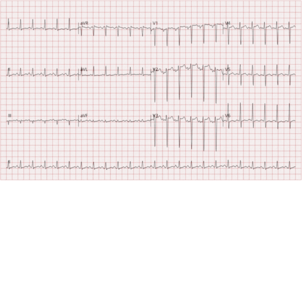 ECG: 동성 빈맥