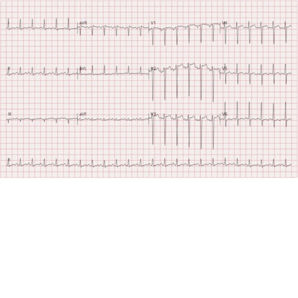 ECG: 동성 빈맥