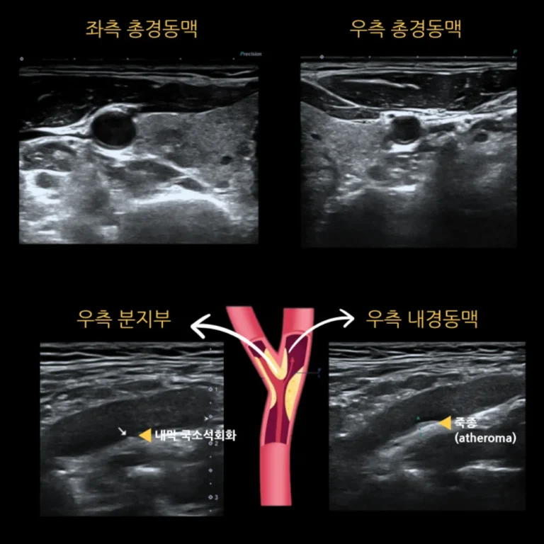 고혈압·당뇨·고지혈증 — 경동맥 초음파에서 경증 죽상경화성 협착