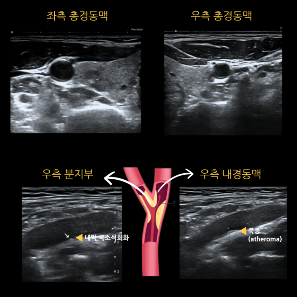 고혈압·당뇨·고지혈증 — 경동맥 초음파에서 경증 죽상경화성 협착