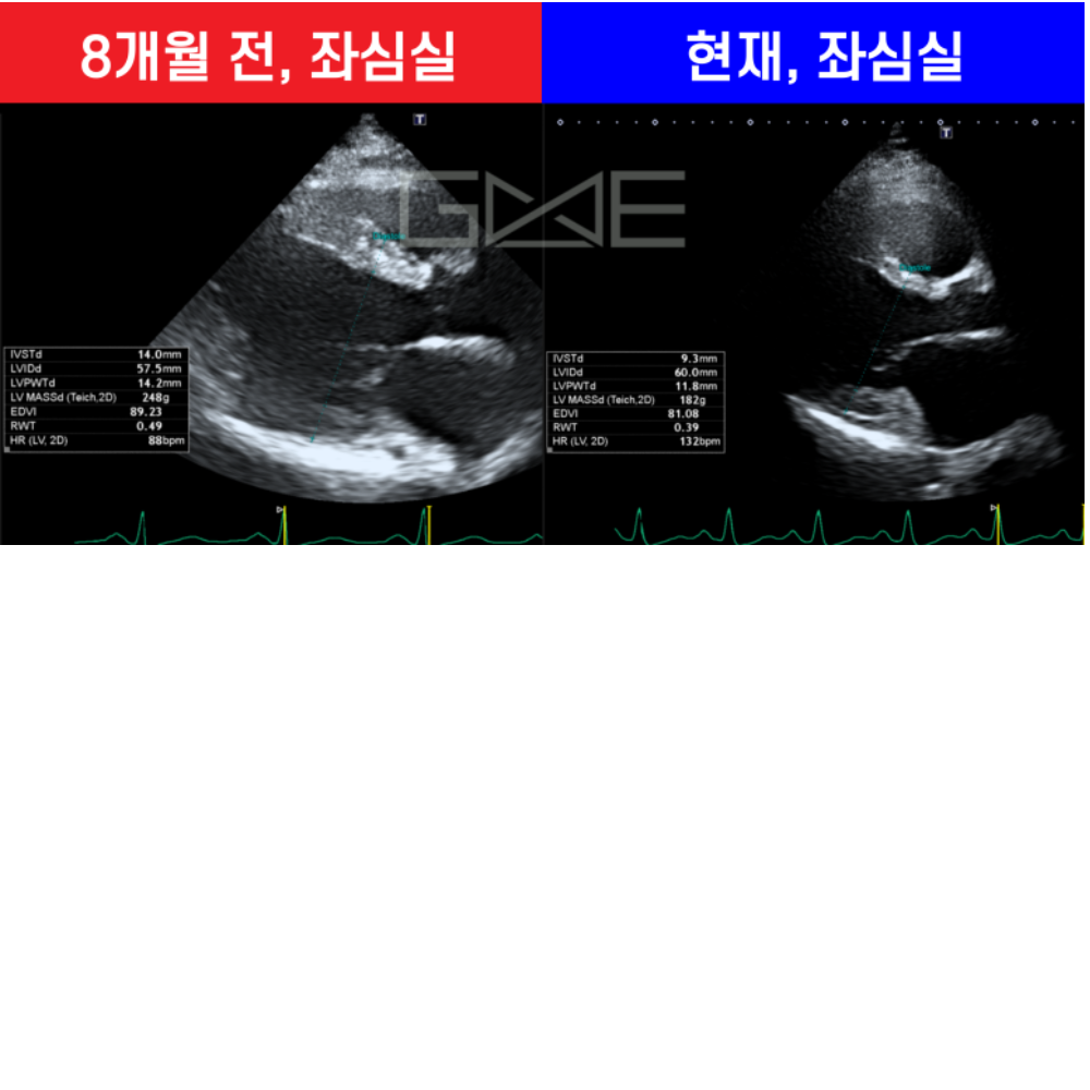 8개월 추적 — EF 25%→59%, 좌심실·좌심방 크기 개선으로 확인된 심부전 호전