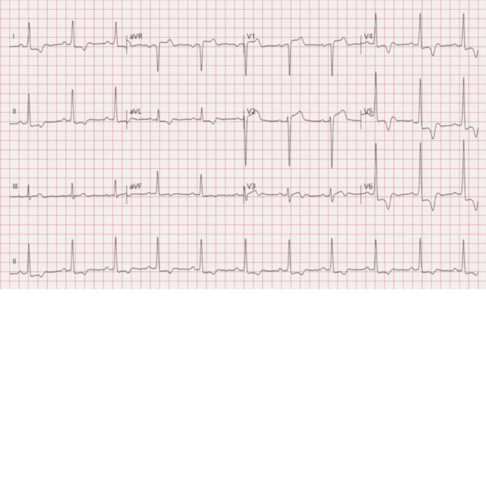 ECG: 좌심실비대