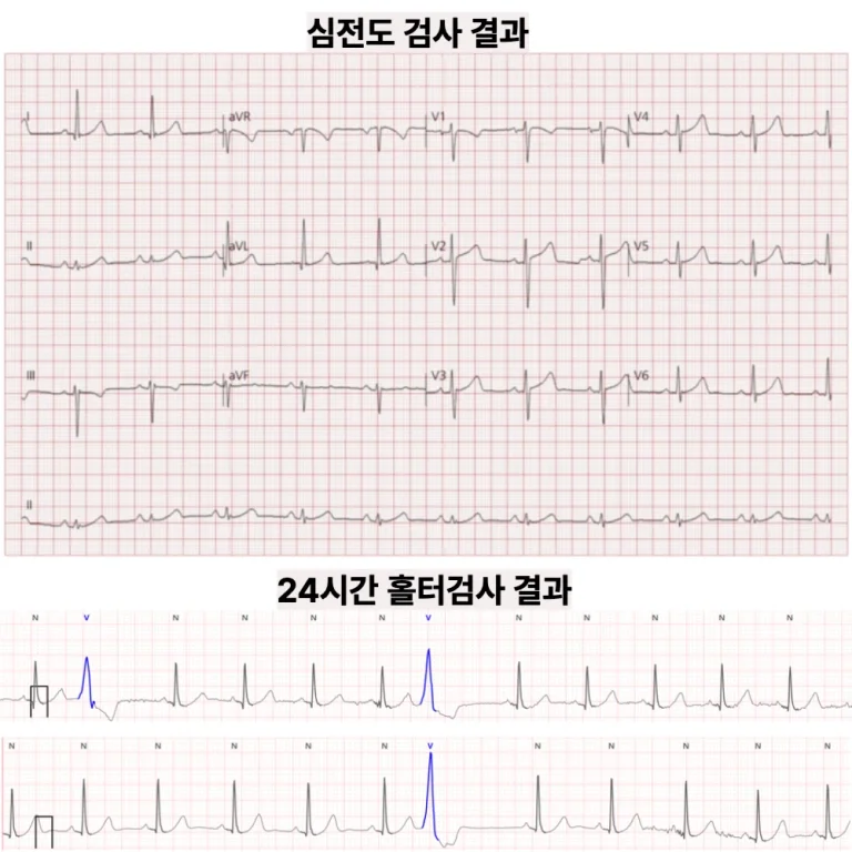두근거림, 심전도 정상이어도 — 홀터에서 심실조기수축 확인
