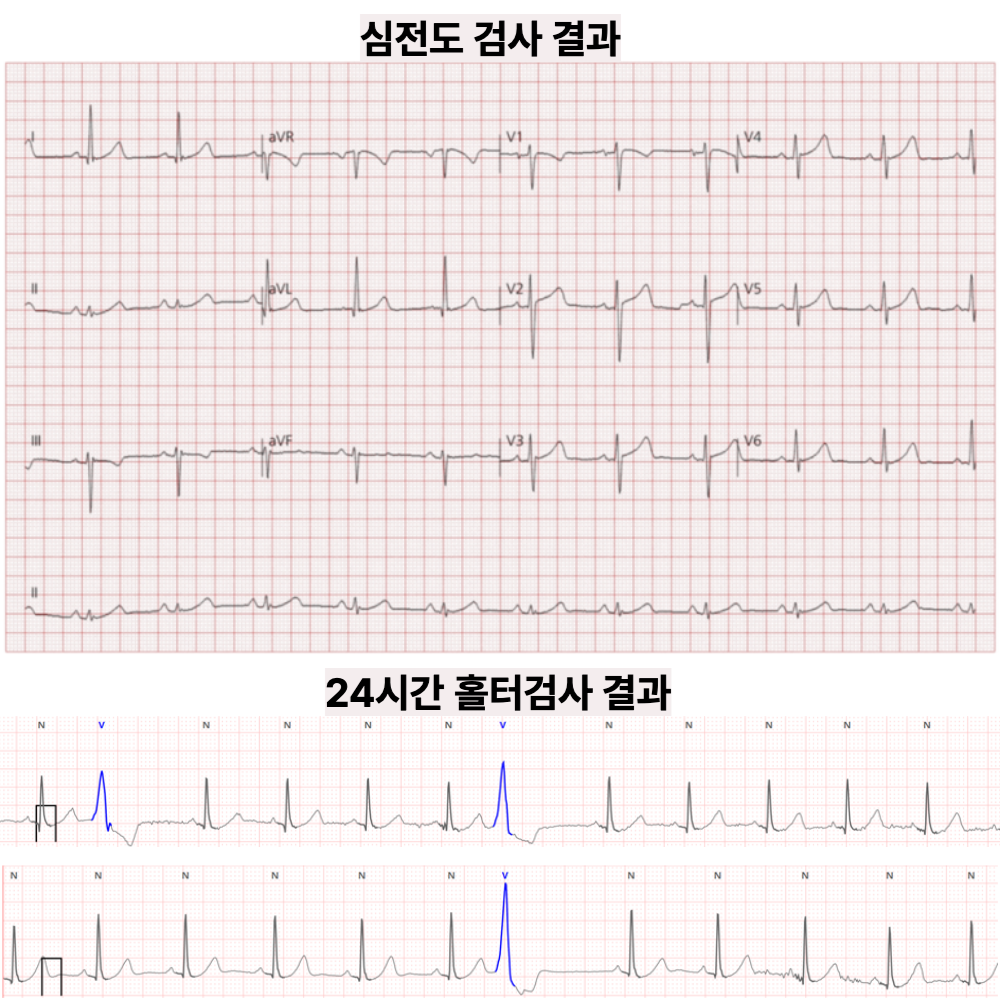 두근거림, 심전도 정상이어도 — 홀터에서 심실조기수축 확인