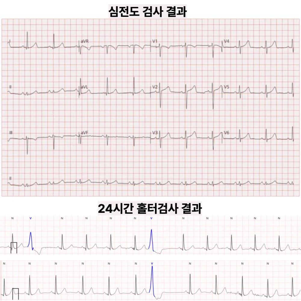 두근거림, 심전도 정상이어도 — 홀터에서 심실조기수축 확인