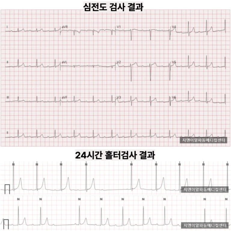 두근거림·어지럼·숨참 — 24시간 홀터에서 2도 방실차단 진단