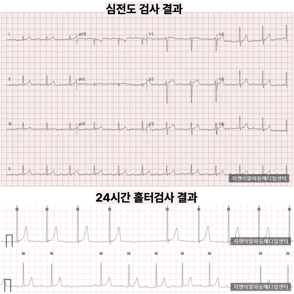 두근거림·어지럼·숨참 — 24시간 홀터에서 2도 방실차단 진단