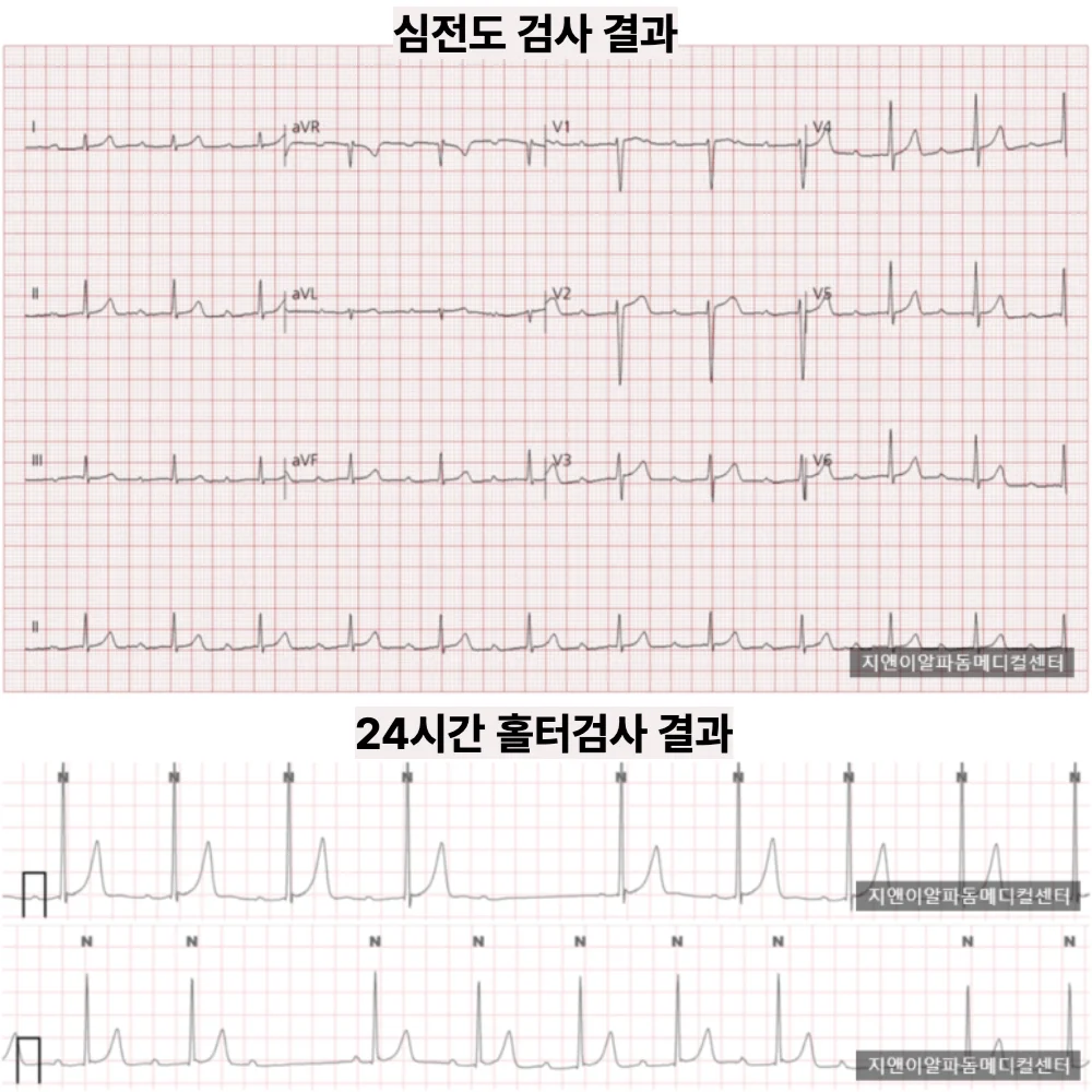 두근거림·어지럼·숨참 — 24시간 홀터에서 2도 방실차단 진단