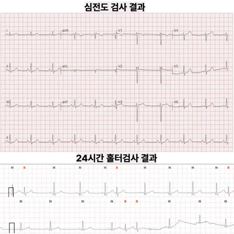 두근거림, 원인이 안 잡힐 때 — 홀터에서 확인된 심방 조기수축