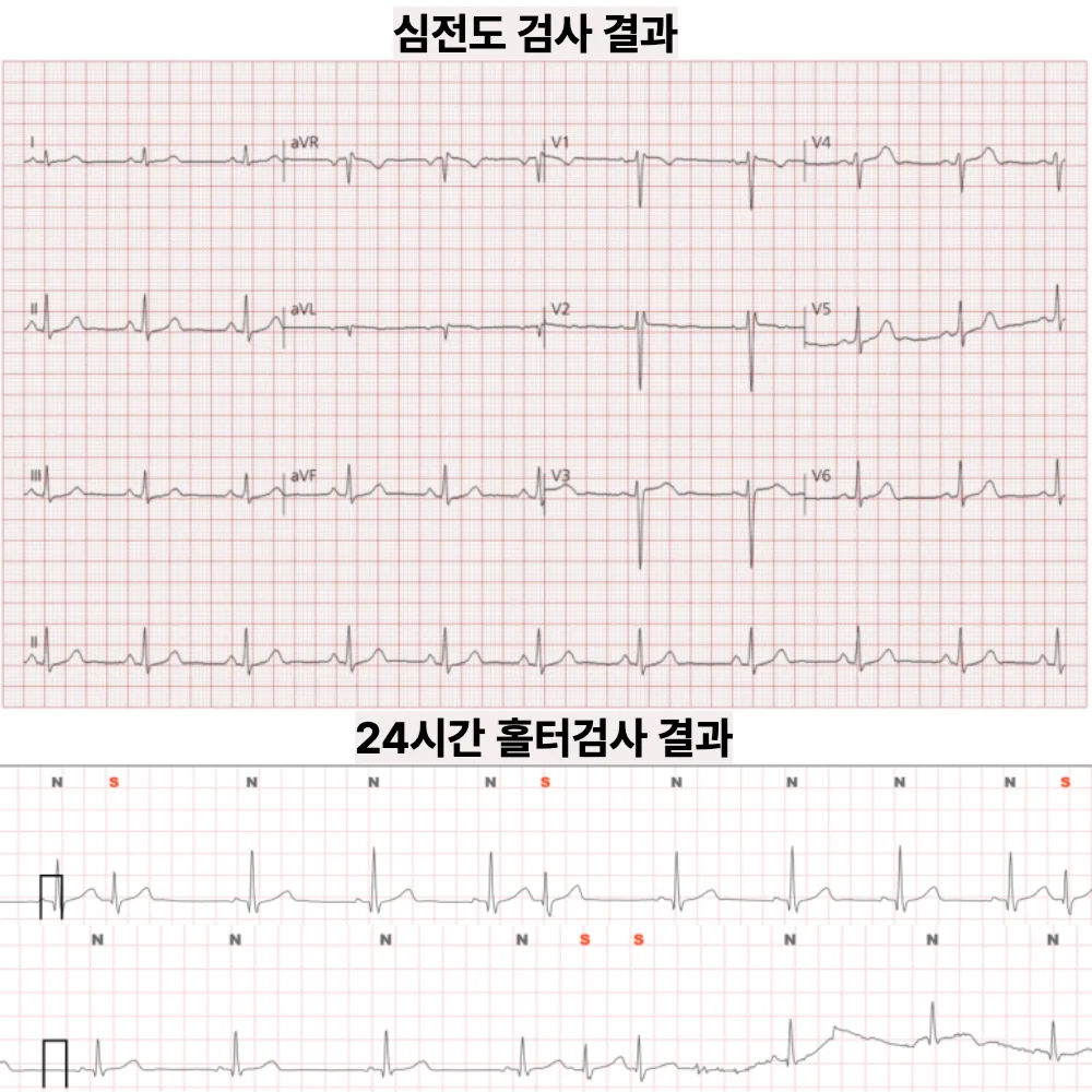 두근거림, 원인이 안 잡힐 때 — 홀터에서 확인된 심방 조기수축