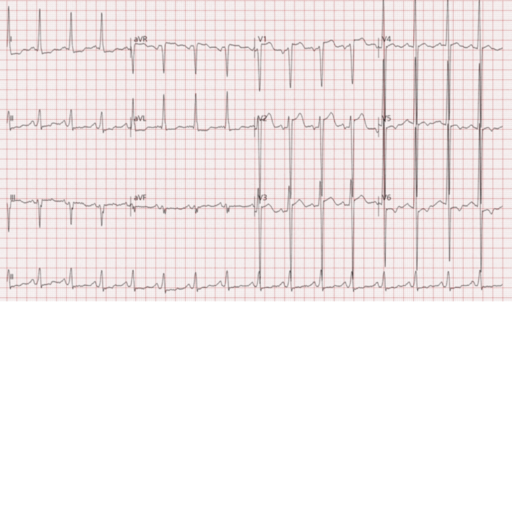 ECG: 심비대 및 심혈관 질환 의심 소견