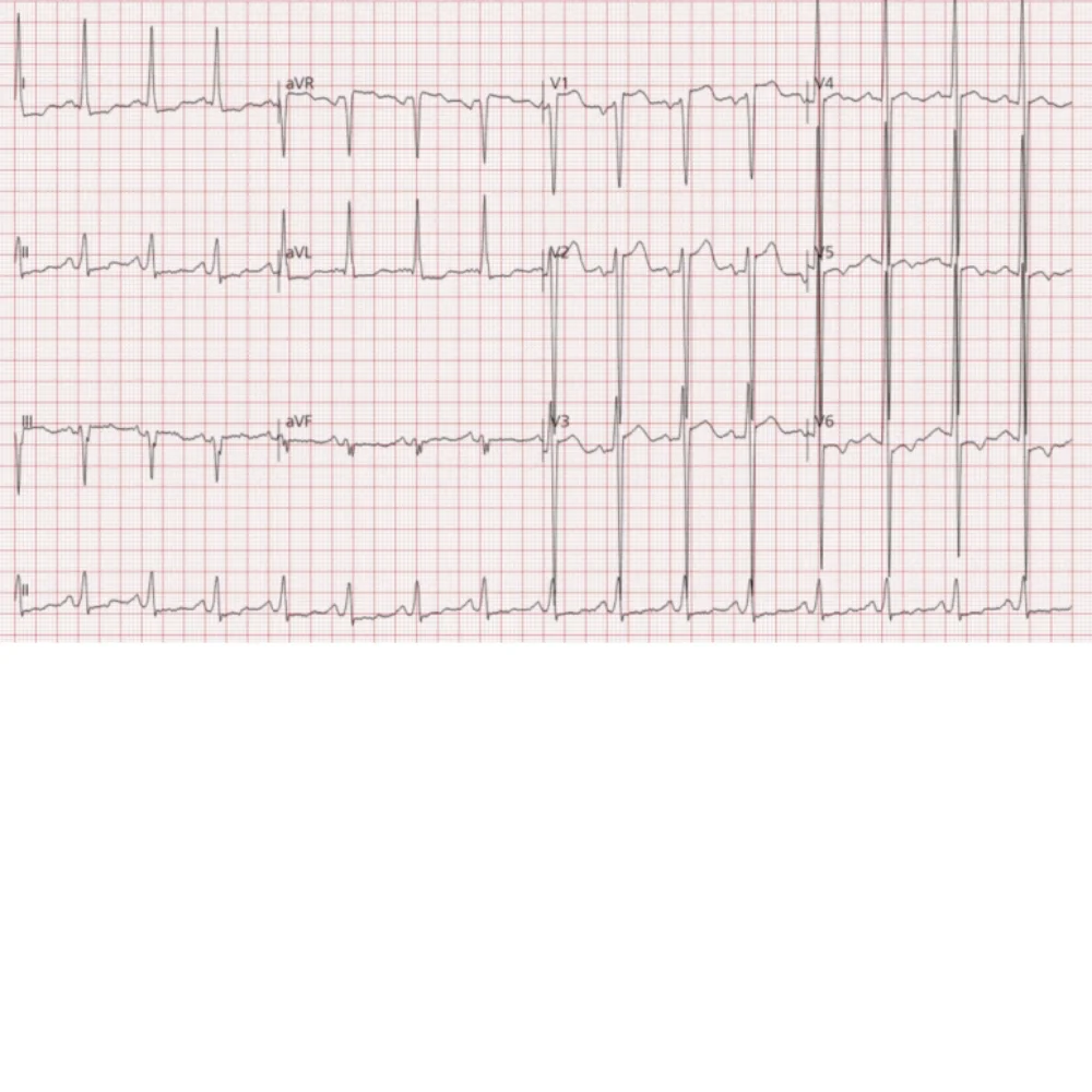 ECG: 심비대 및 심혈관 질환 의심 소견