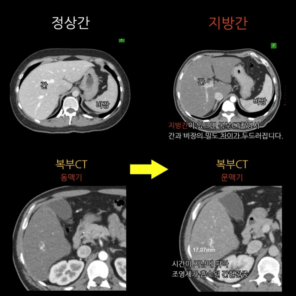 CT 검사 결과