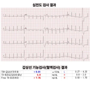 20대 여성의 두근거림·어지럼 — ‘갑상선기능항진증’과 연관된 빈맥·부정맥