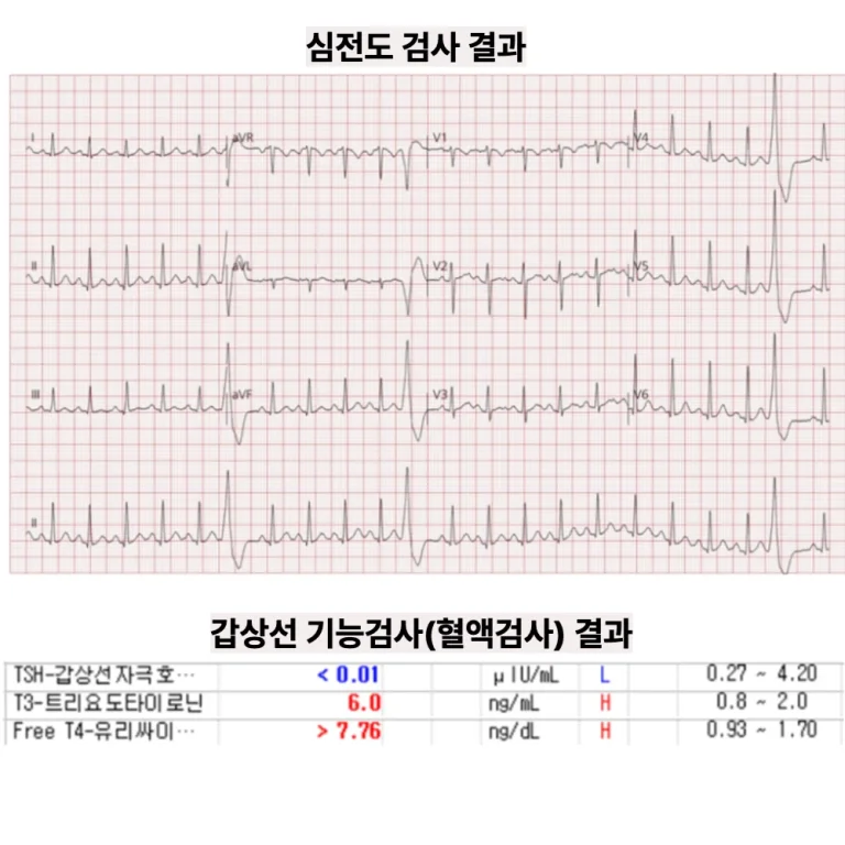 20대 여성의 두근거림·어지럼 — ‘갑상선기능항진증’과 연관된 빈맥·부정맥